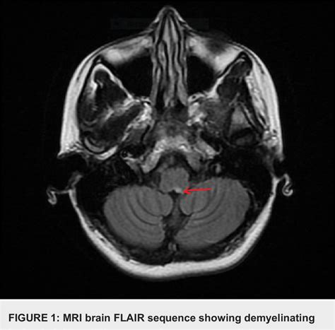 Figure 1 from Isolated Area Postrema Syndrome Presenting as Intractable ...