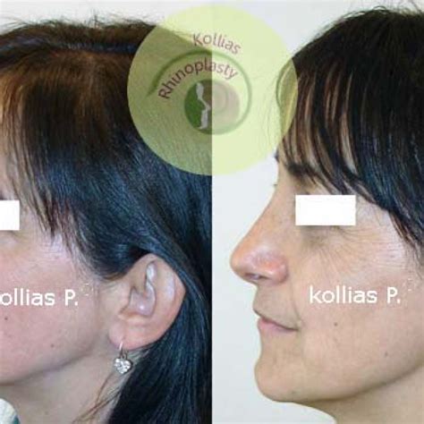 Rhinoplasty Nasal Tip Ptosis 027 Π Κόλλιας