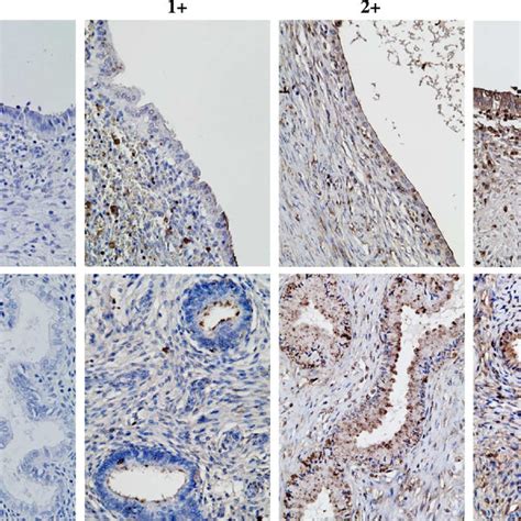 Distribution Of WFA Binding Glycans In Ovarian Endometriotic Cysts And