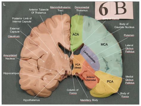 Pathology Of Cerebrovascular Disease Flashcards Quizlet