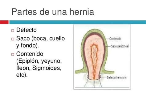 Hernias