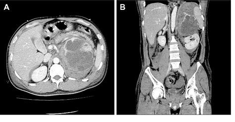 Figure 1 From Composite Pheochromocytoma With A Malignant Peripheral Nerve Sheath Tumor Case