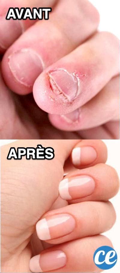 Astuces Qui Marchent Pour Ne Plus Jamais Vous Ronger Les Ongles En