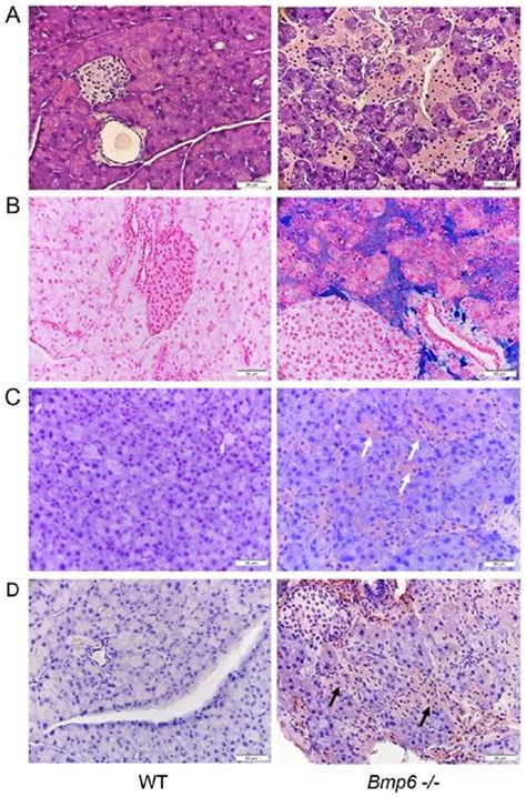 Iron Overload In Aging Bmp6 Mice Induces Exocrine Pancreatic Injury And Fibrosis Due To Acinar