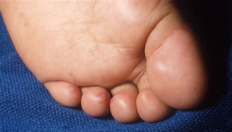 Pie, mano, boca | Sociedad de Pediatría de Atención Primaria de Extremadura