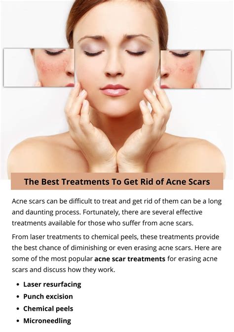 Ppt The Best Treatments To Get Rid Of Acne Scars Powerpoint