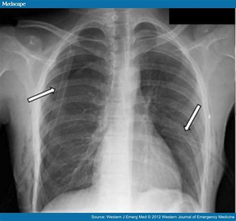 Bilateral Spontaneous Pneumothorax