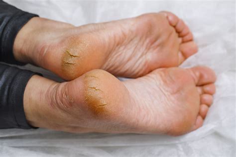 Foot Fissures Symptoms Causes Treatment Prevention And Remedies