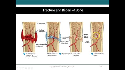 4 Bone Repair And Fractures YouTube