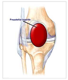 Prepatellar Bursitis Natural Treatment | OSMO Patch UK