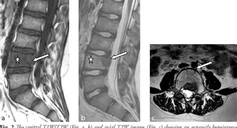 Osteoblastoma Radiology