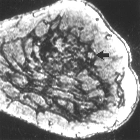 Outcome Analysis And Rational Management Of Enhancing Lesions