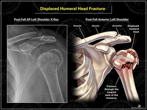 Displaced Humeral Head Fracture