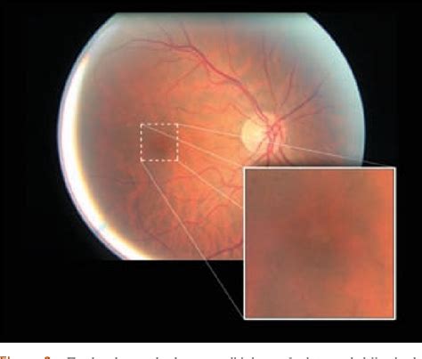 Figure 2 From Diagnosis And Management Of A Full Thickness Macular Hole