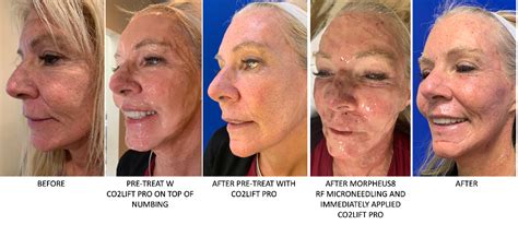 Co Lift Pro Carboxy Treatments Best Kept Secret In Aesthetics