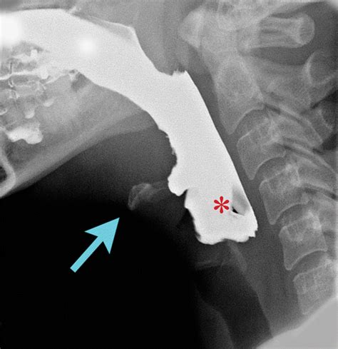 Vallecula Xray