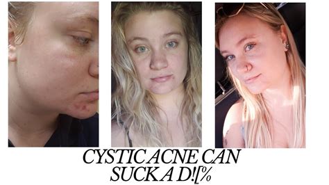 How I Cured My Acne How To Cure Cystic Acne Healing Acne Youtube