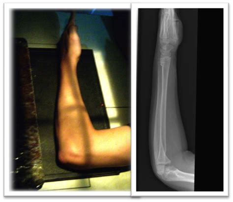 Tecnicas Radiologicas T Cnica Radiogr Fica Para El Antebrazo En