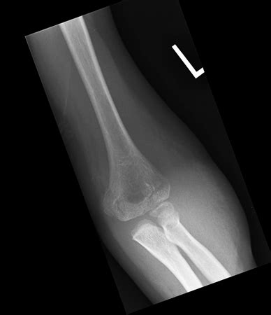 Supracondylar Fracture - Pediatric - Pediatrics - Orthobullets