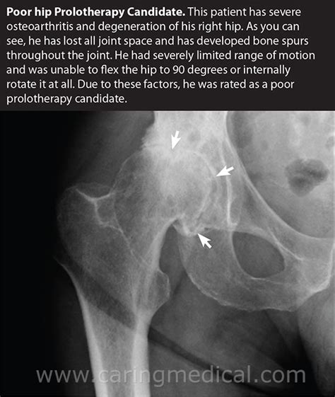 Rapid Destructive Hip Osteoarthritis When Mri And X Rays Off