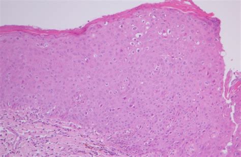 Leukoplakia Tongue Histology