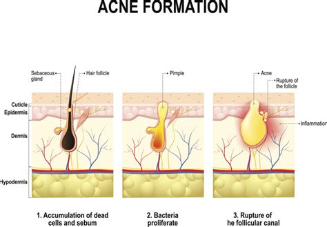 How To Get Rid Of Acne Fast Vargas Face And Skin Center