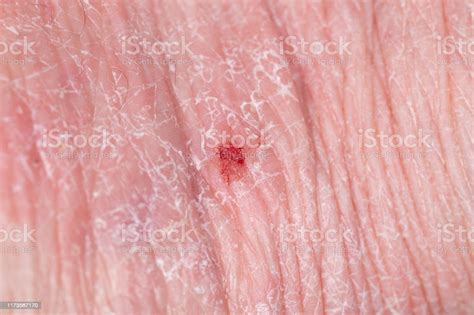 Atopische Dermatitis Dermatitis Huidziekte Stockfoto En Meer Beelden