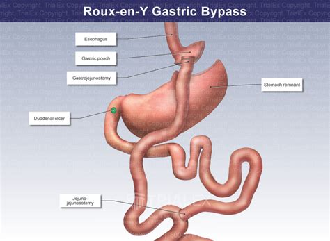 Roux En Y Gastric Bypass Trialquest Inc