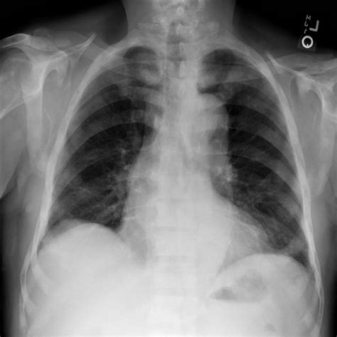 How To Use The Pleural Effusion Chest X Ray Object Detection Api