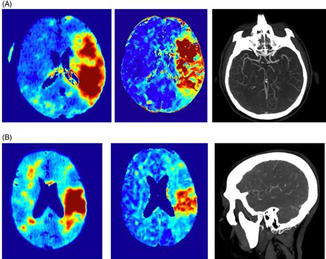 Validation Of A Novel Multiphase CTA Perfusion Tool Compared To CTP In