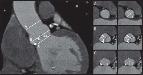 Sections used for measurements of the aortic annulus and aortic root ...