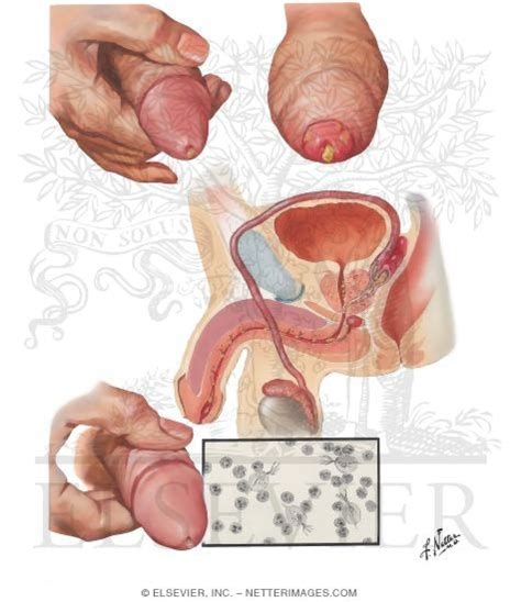 Urethritis In Men