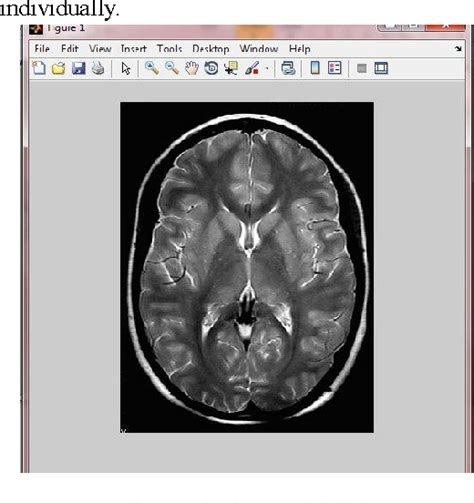 Figure 2 From Denoising MRI Images Using A Non Linear Digital Filter