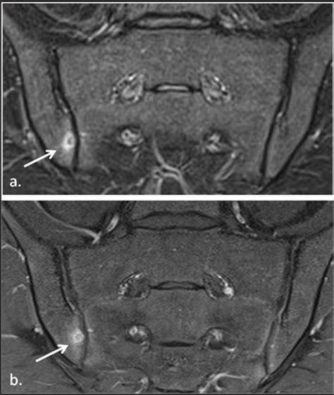 Figure 16 From Diagnostic Value Of MRI Of The Sacroiliac Joints In