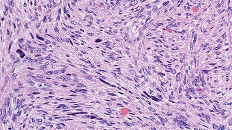 Leiomyosarcoma Atlas Of Pathology