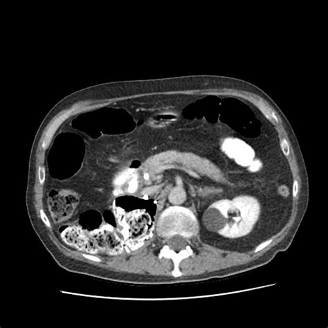 Pancreatic Metastases Likely From Renal Cell Carcinoma Image