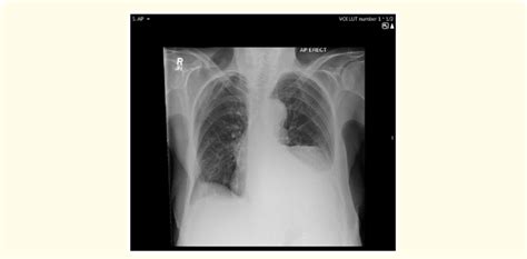 Portable Chest X Ray Showing Widened Mediastinum Download Scientific