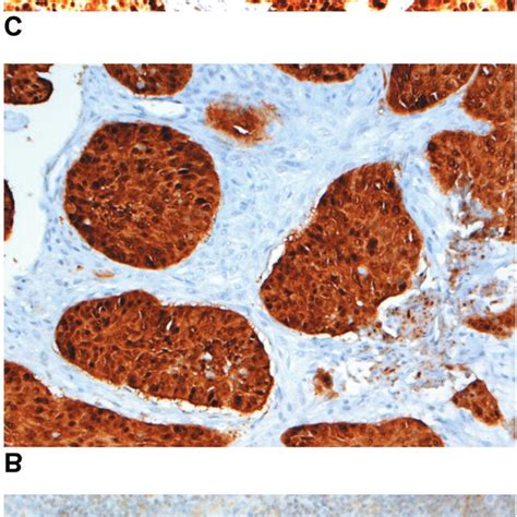 Immunohistochemical Staining Images Of P In Oral Squamous Cell