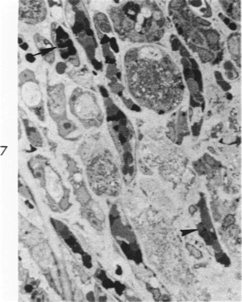 Vascularization Of Normal And Neoplastic Tissues Grafted To The Chick