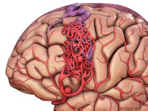 Arteriovenous Malformation Images Aans Cns Cerebrovascular Section