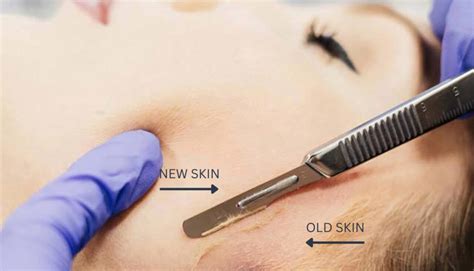 Dermaplaning Benefits Smooth Bright Skin Skinduced