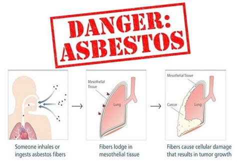 Asbestosis Causes | Mesohealth