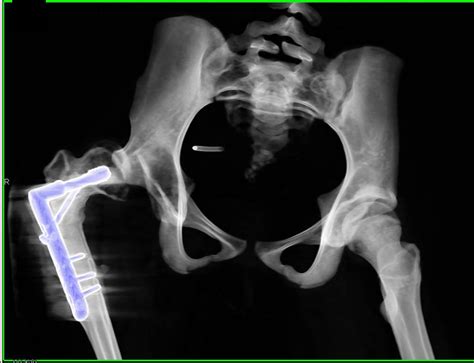 Hip Dysplasia With Shallow Acetabulum And Orif Musculoskeletal Case
