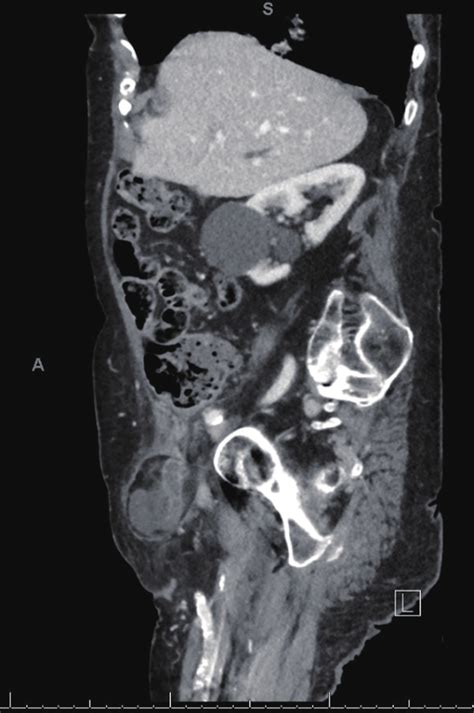 Ct Sagittal Scan Right Femoral Hernia Containing An Inflamed Cecal