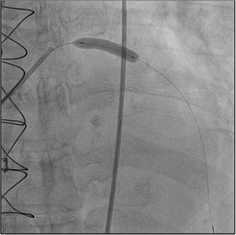 Tctap C A Challenging Case Report Coronary Intervention In A