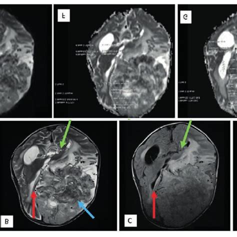 Rhabdoid Meningioma WHO Grade III ICD 9358 3 A T1WI B T2WI C