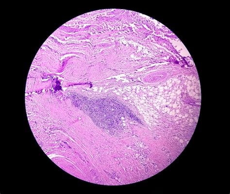 Premium Photo Microscopic Examination Of Thyroglossal Duct Cyst