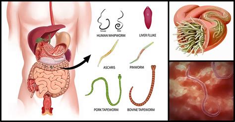 Warning Signs And Symptoms That Our Body May Be Full Of Parasites Dr