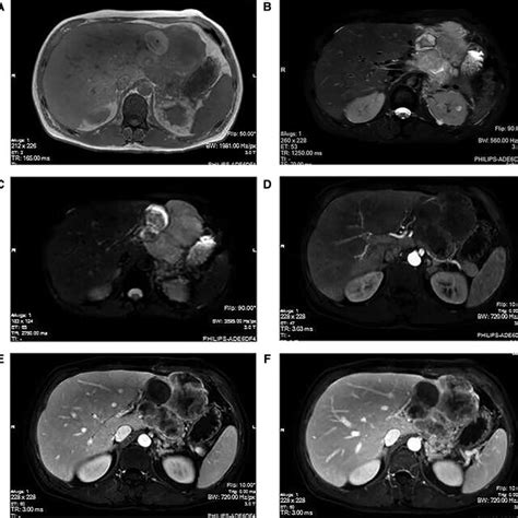 Mri Manifestations Of Hepatic Sarcomatoid Carcinoma The Magnetic