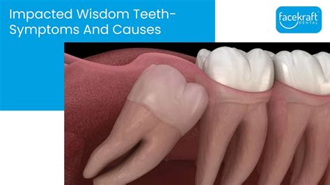 Impacted Wisdom Teeth Symptoms And Causes Face Kraft Clinic